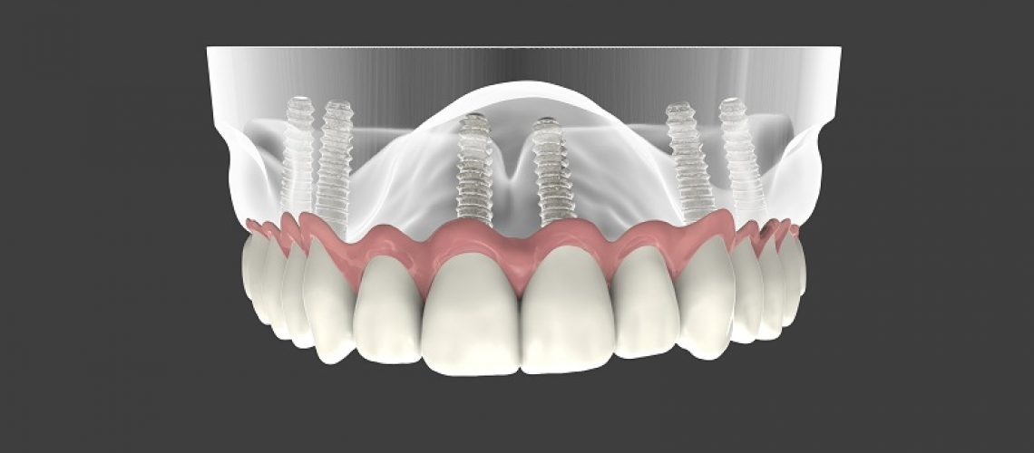 Implantologia dentale: il carico immediato è un intervento per tutti?